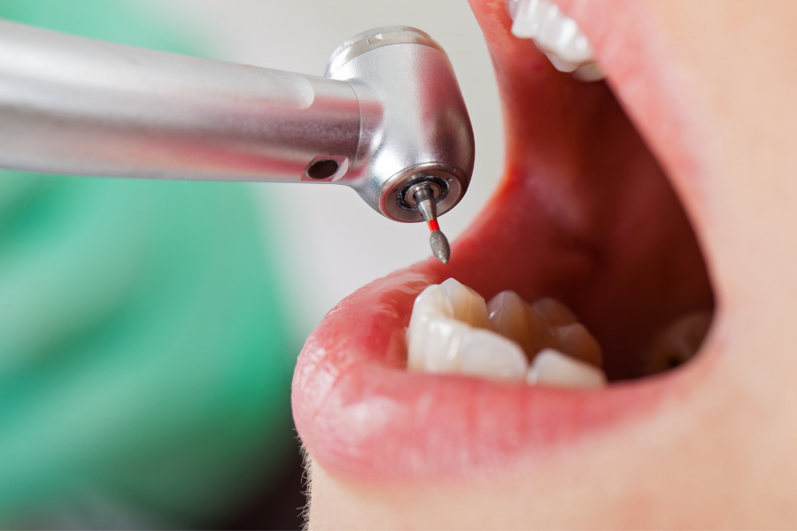 La endodoncia y sus ventajas
