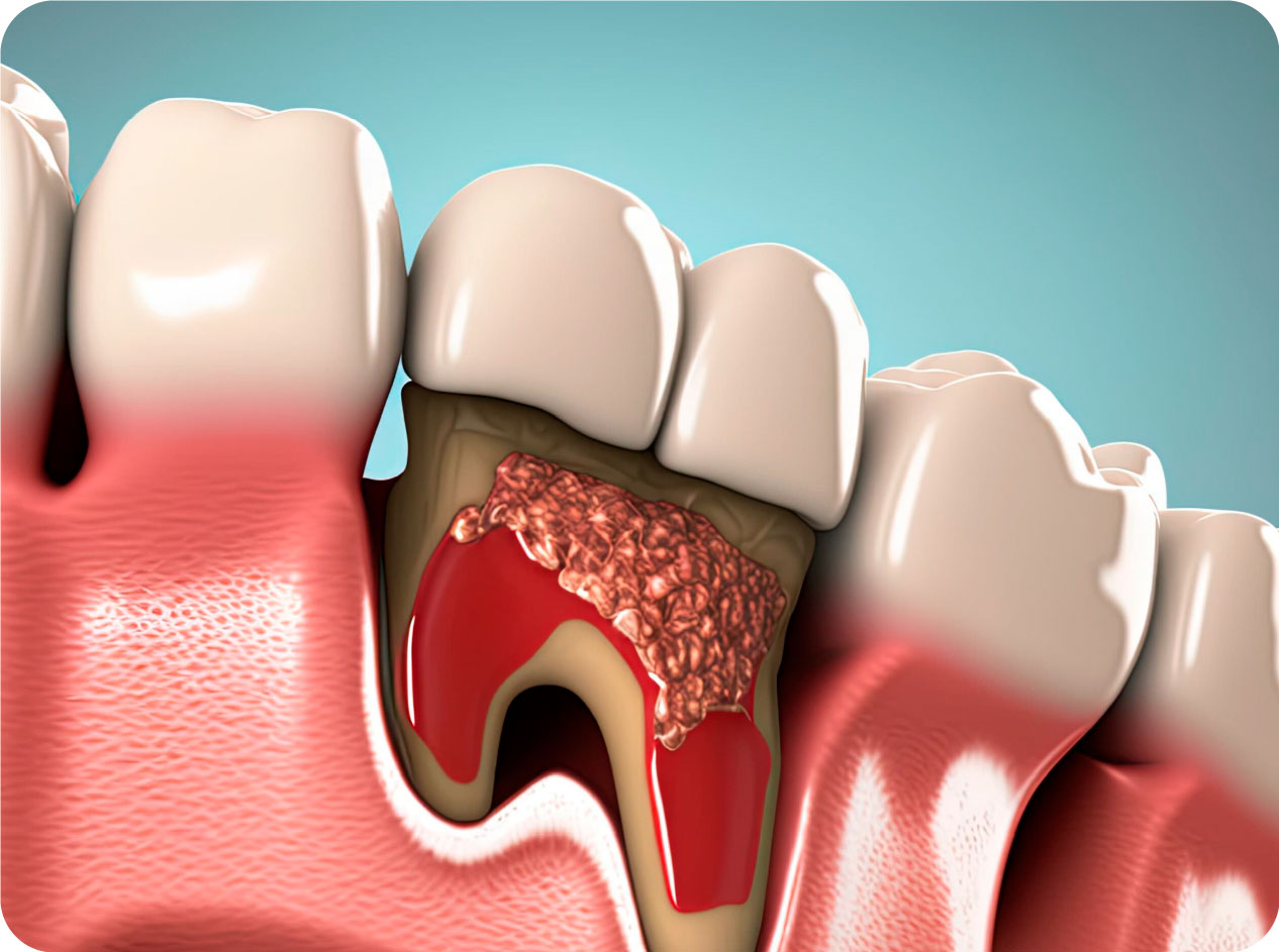 periodoncia 15