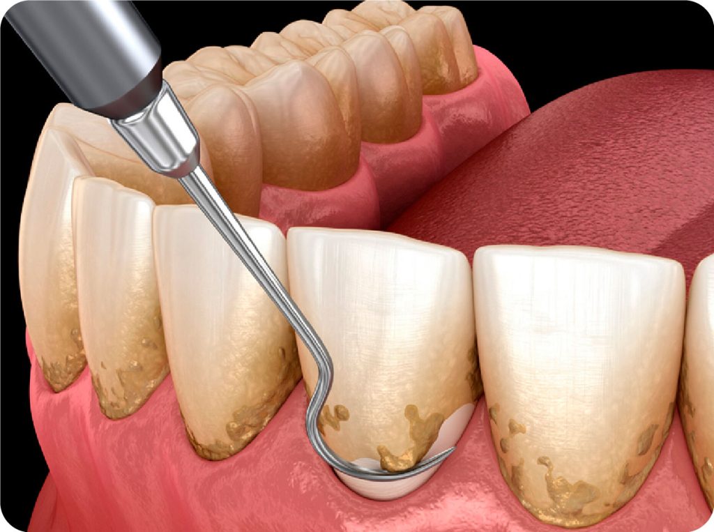 periodoncia 16