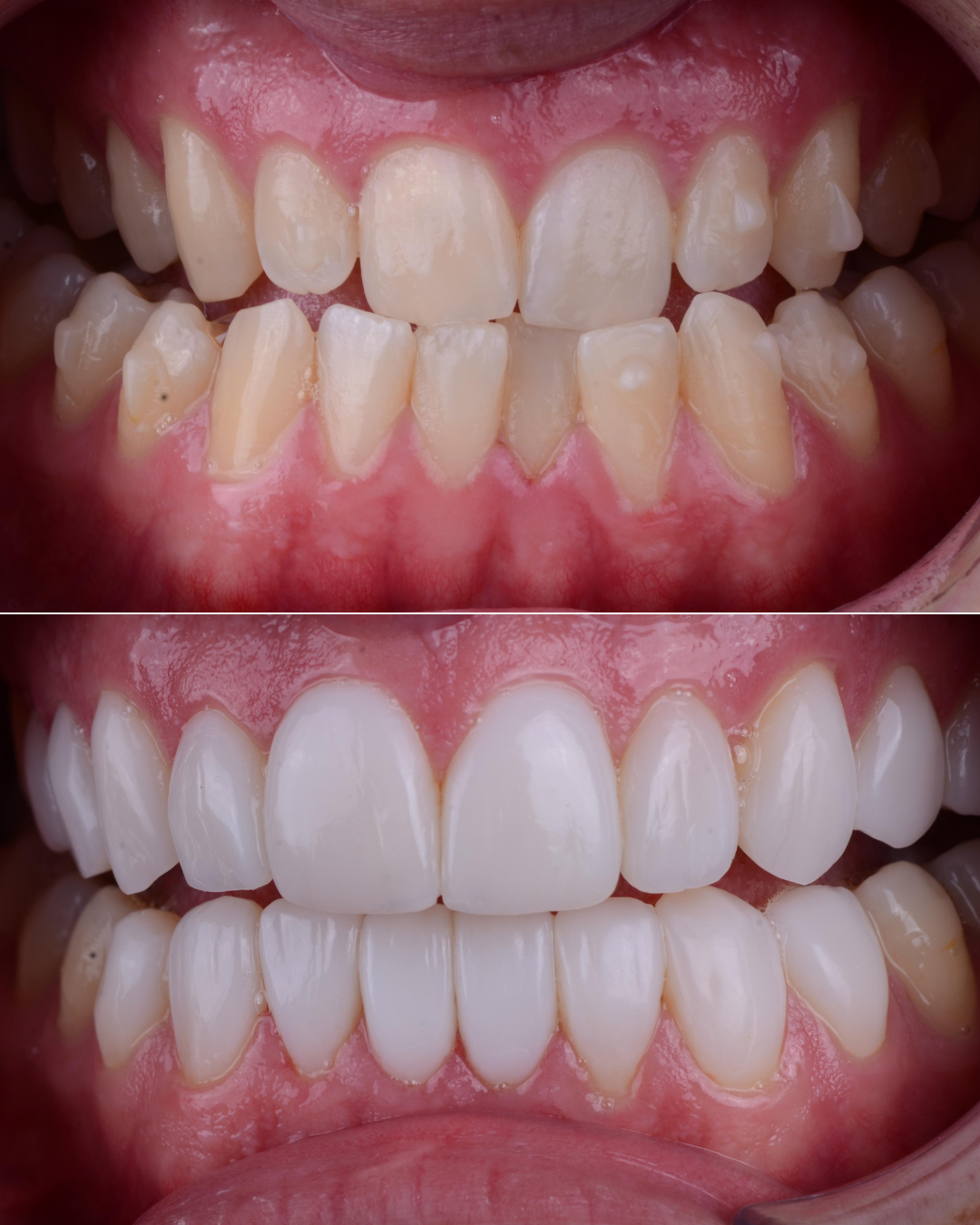 carillas dental valencia