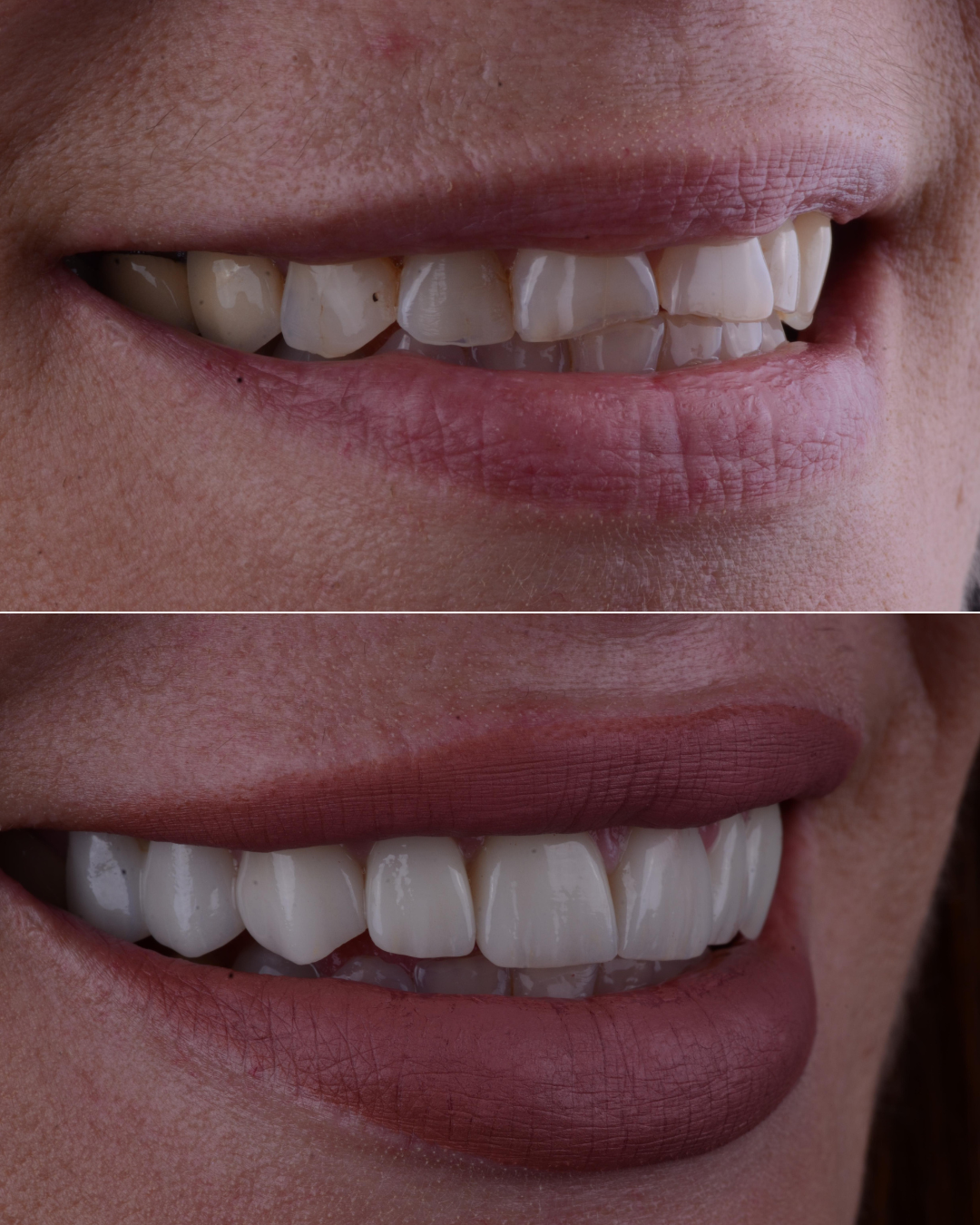 carillas dental valencia