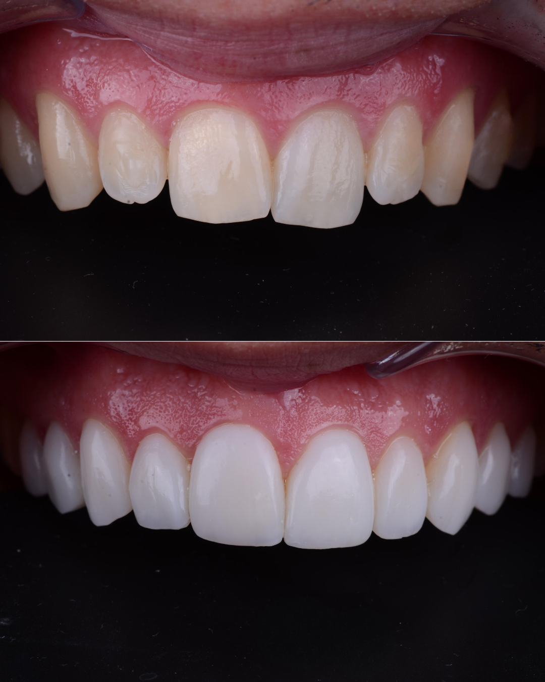 carillas dental valencia